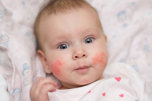 How to help babies with Eczema